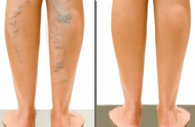 Venous veins before and after surgery