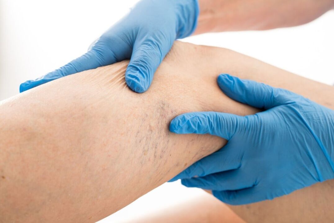 Clinical cartin veins