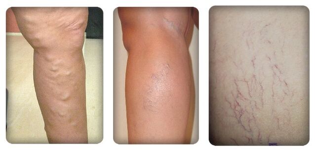 The stages of varicose veins