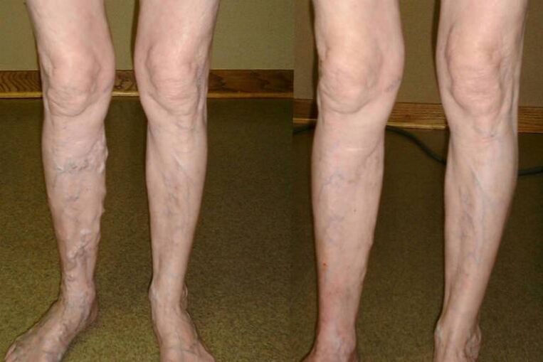 intravenous veins in men