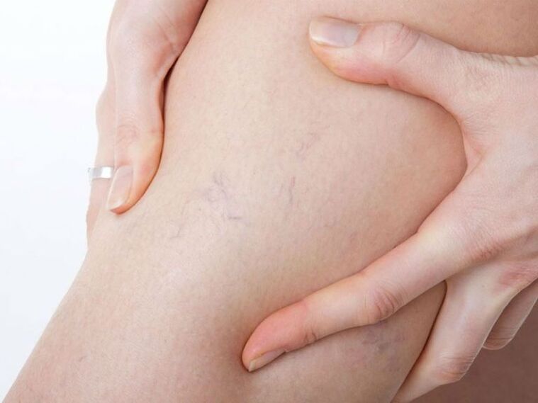 intravenous veins on the legs