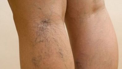 Causes of varicose veins