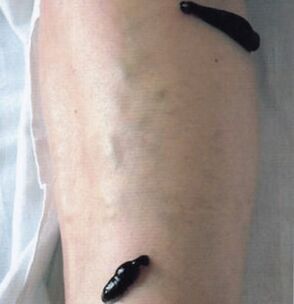 Hirud therapy as a method of treating varicose veins