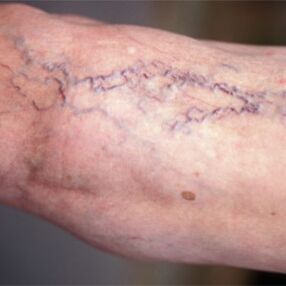 Varicose veins