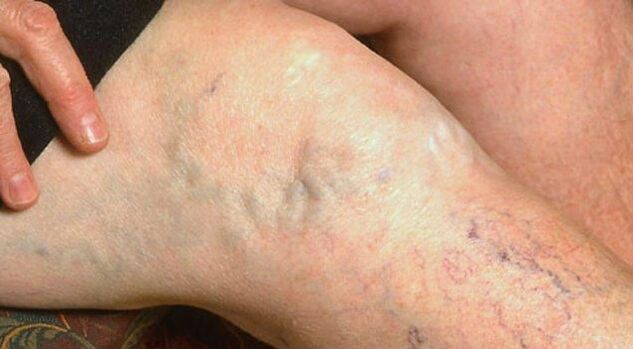 Clear signs of varicose veins in the legs