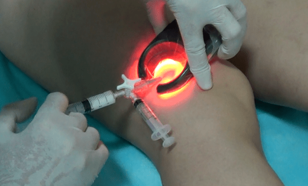 Sclerotherapy is an effective treatment for varicose veins in the legs