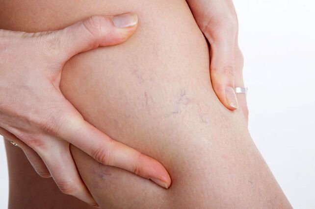 The first appearance of varicose veins in the legs