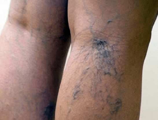 varicose veins in the legs